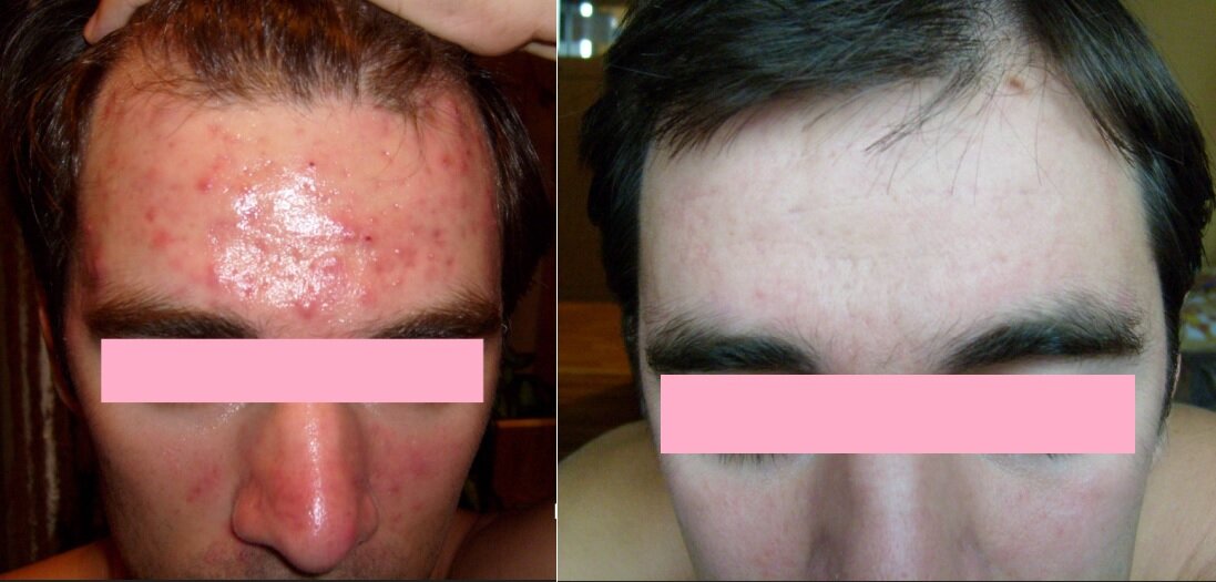                                 До                                                     После лечения в 2008 г.