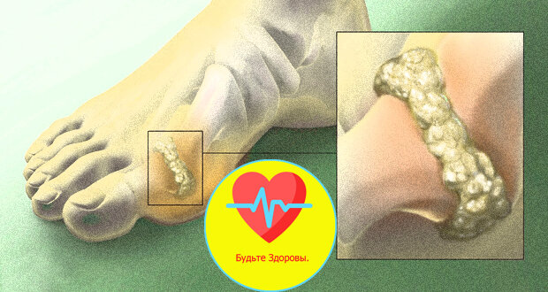 Воспаленный сустав.