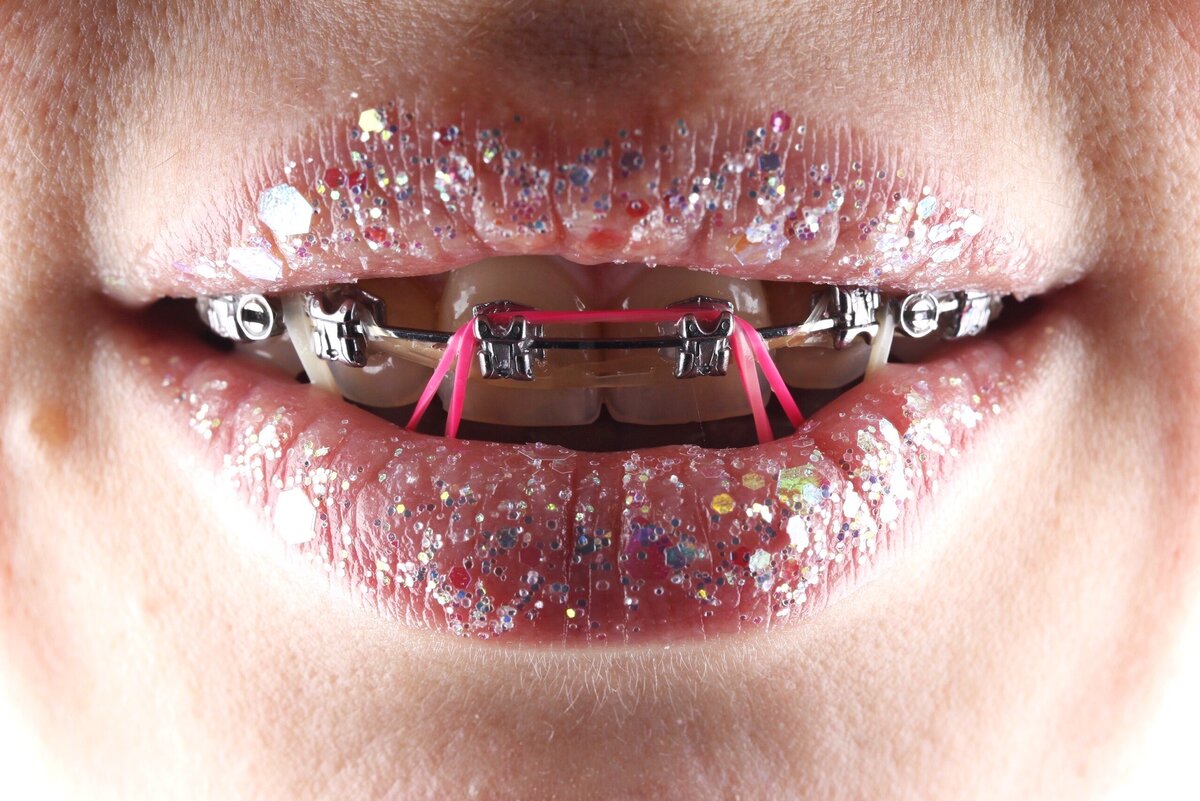 брекеты