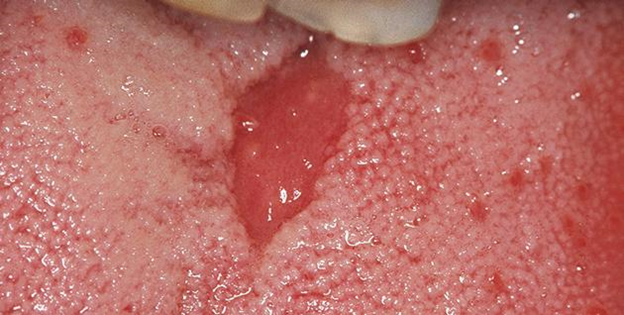 На фото ромбовидный глоссит. Фото: Яндекс.Картинки