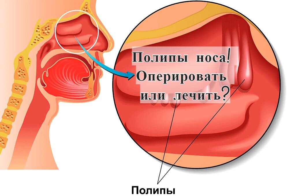 Полип носа — Википедия