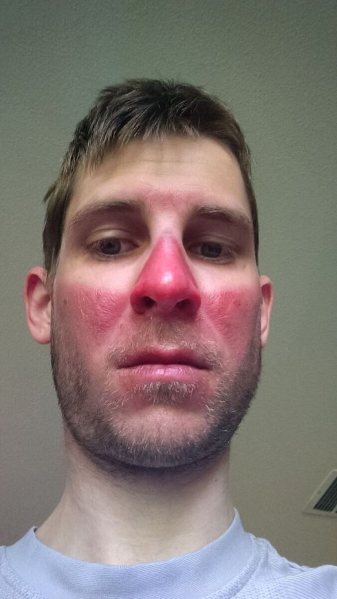 Примерно вот так, я представлял свое лицо от прилива крови. 