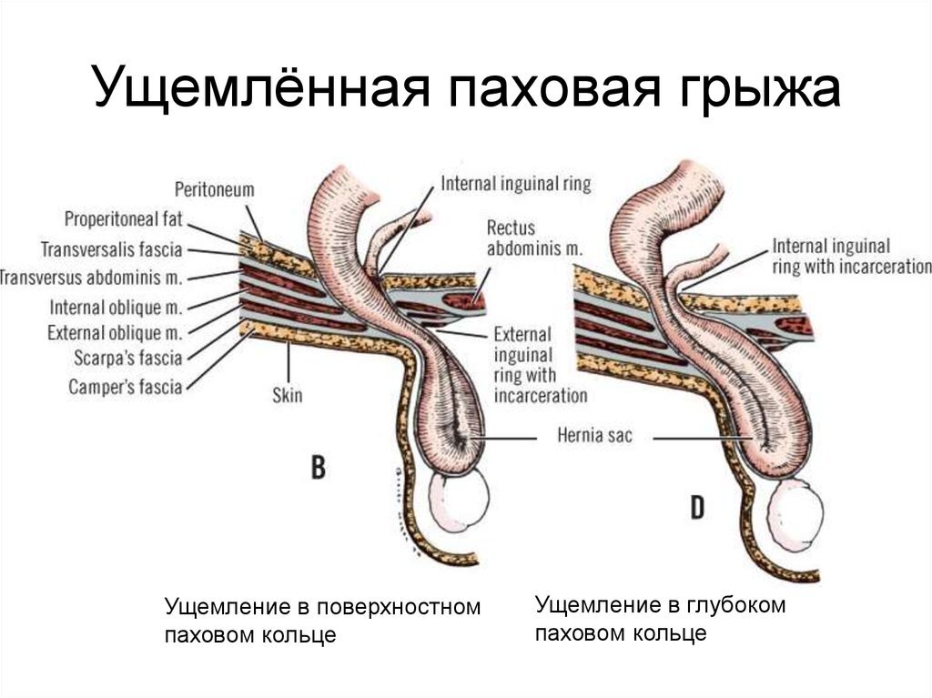 Ущемленная паховая грыжа статус локалис карта смп