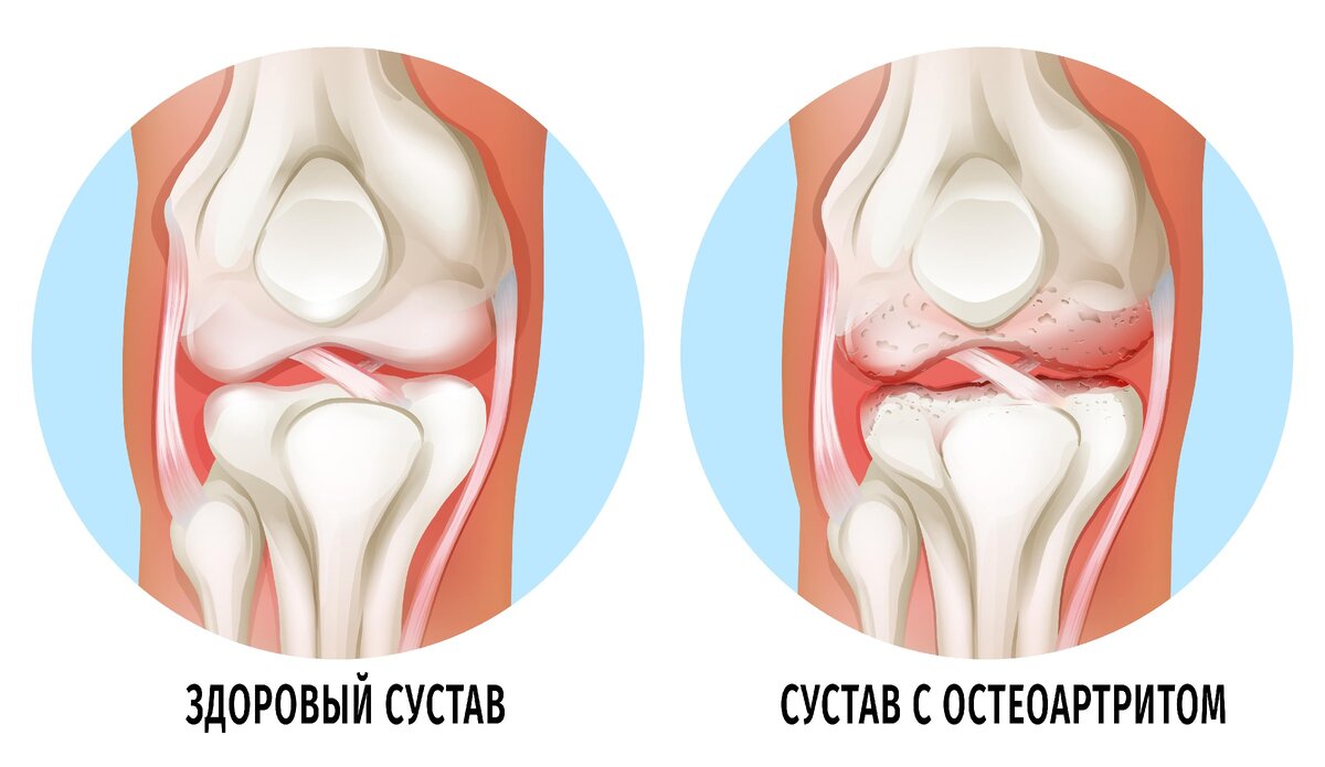 Остеоартрит