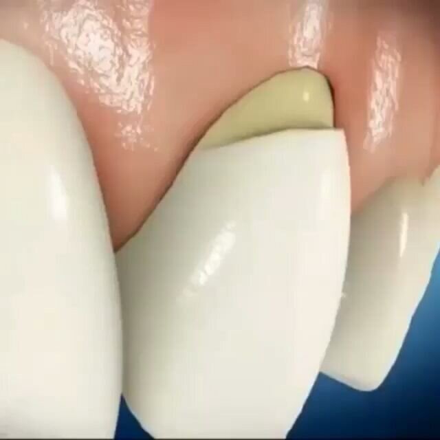 Так выглядит клиновидный дефект в запущенной стадии. Картинка из свободных источников.