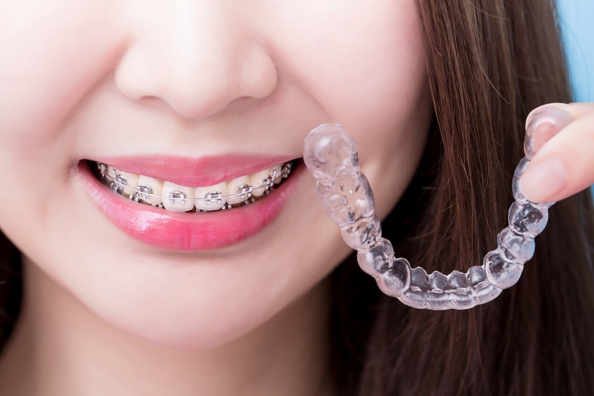 Что лучше элайнеры или брекеты для выравнивания. Invisalign брекеты. Инвизибл элайнеры.