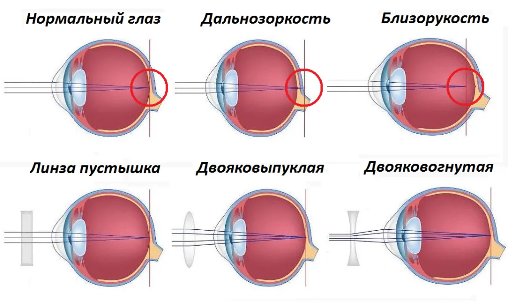 Дальнозоркость и близорукость строение глаза. Строение глаза при миопии. Близорукость строение глаза. Строение глаза при близорукости и дальнозоркости. Линзы для зрения дальнозоркость