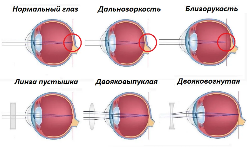 Болезнь дальнозоркость