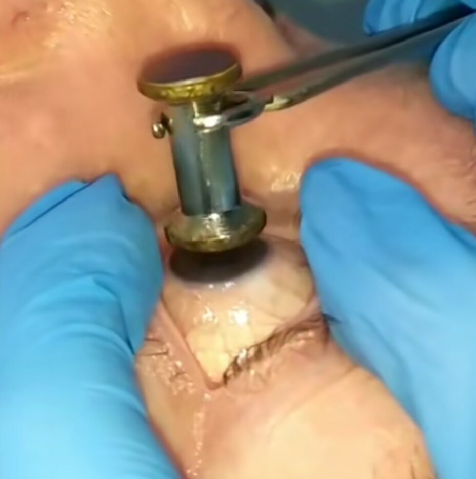 Процесс измерения глазного давления по Маклакову - на глаз под местной анестезией ставят грузик с краской, затем измеряют отпечаток