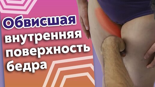 Что делать, если внутренняя поверхность бедра обвисла? Как убрать целлюлит на бёдрах?