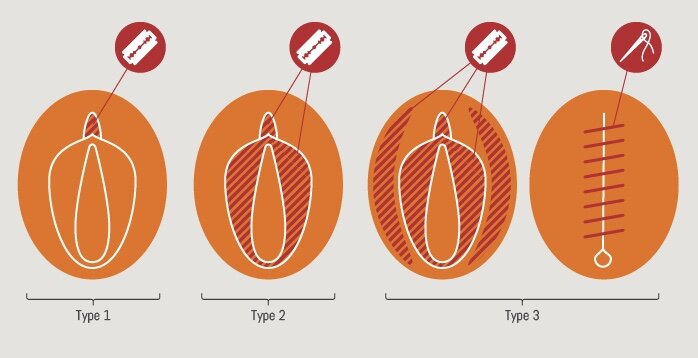 3 вида женского обрезания