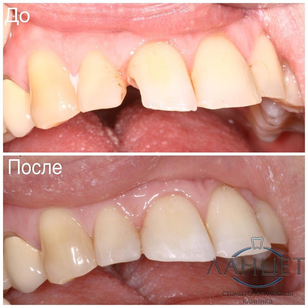 Что делать если откололся зу Реставрация композитным материальном.
Врач Стрельцов Ю.Г.
