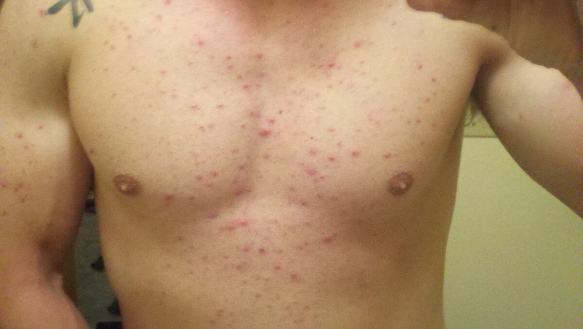 Акне. Одна из многочисленных мерзких побочек.