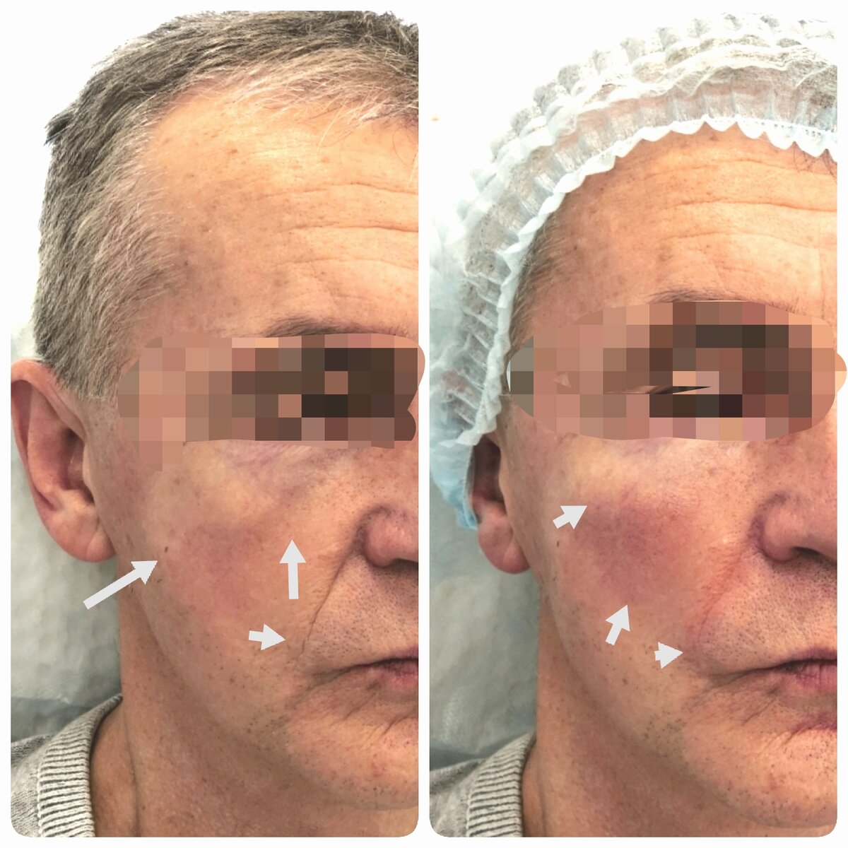 Фото до и сразу после процедуры 