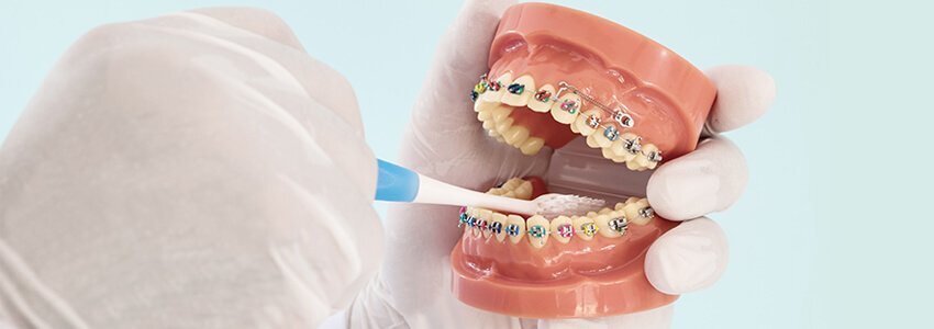 При лечении на брекетах важно придерживаться определенных ограничений в выборе продуктов питания и тщательно следить за гигиеной.