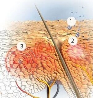 В этом случае зуд сам по себе не опасен и лечить его не надо. По мере ослабления стресса, этот симптом уменьшается и в конечном итоге исчезает. Но снижение стресса в организме часто занимает гораздо больше времени, чем мы думаем.
Тем не менее, когда организм полностью восстановится после гиперстимуляции стресс-реакции, это ощущение жжения и зуда на коже полностью исчезнет.
1. Влага теряется, вызывая сухость. 2. Микровоспалительные процессы вызывают дальнейшее раздражение. 3. Кожа головы начинает чесаться
