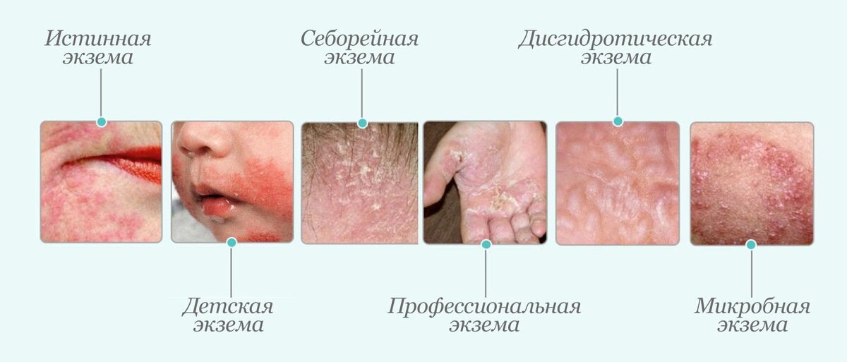 Обострение экземы у взрослых: причины, симптомы, рекомендации по уходу | Pharmacosmetica.ru | Дзен