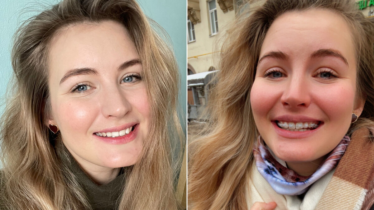До и после установки брекетов