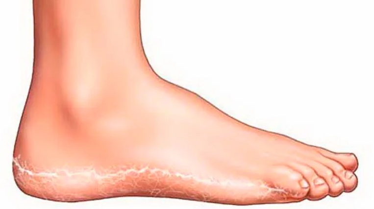 Грибок стопы