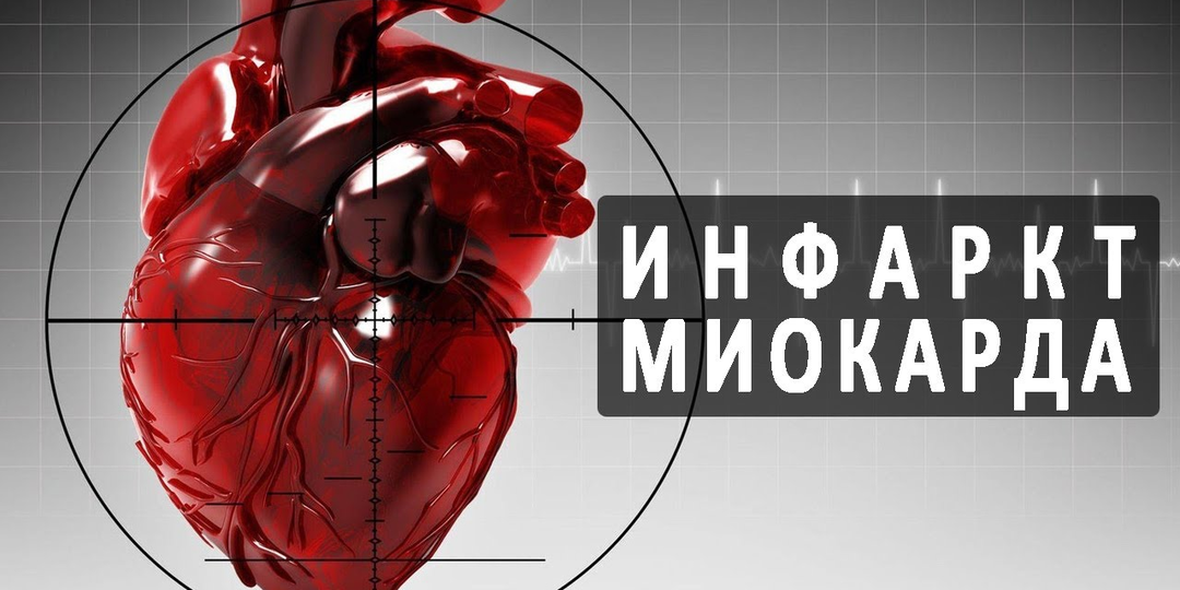 Инфаркт миокарда: почему он возникает, как проявляется и чем его лечат в клинике
