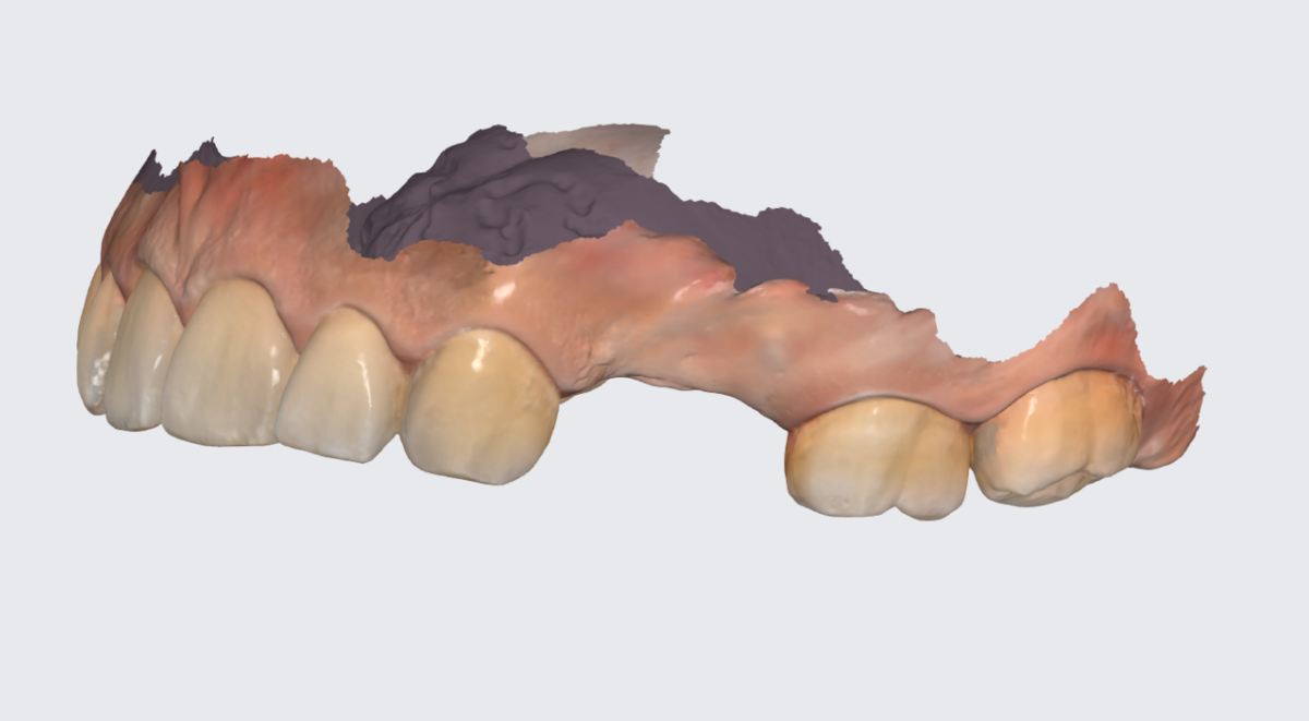Цифровой слепок верхней челюсти. 