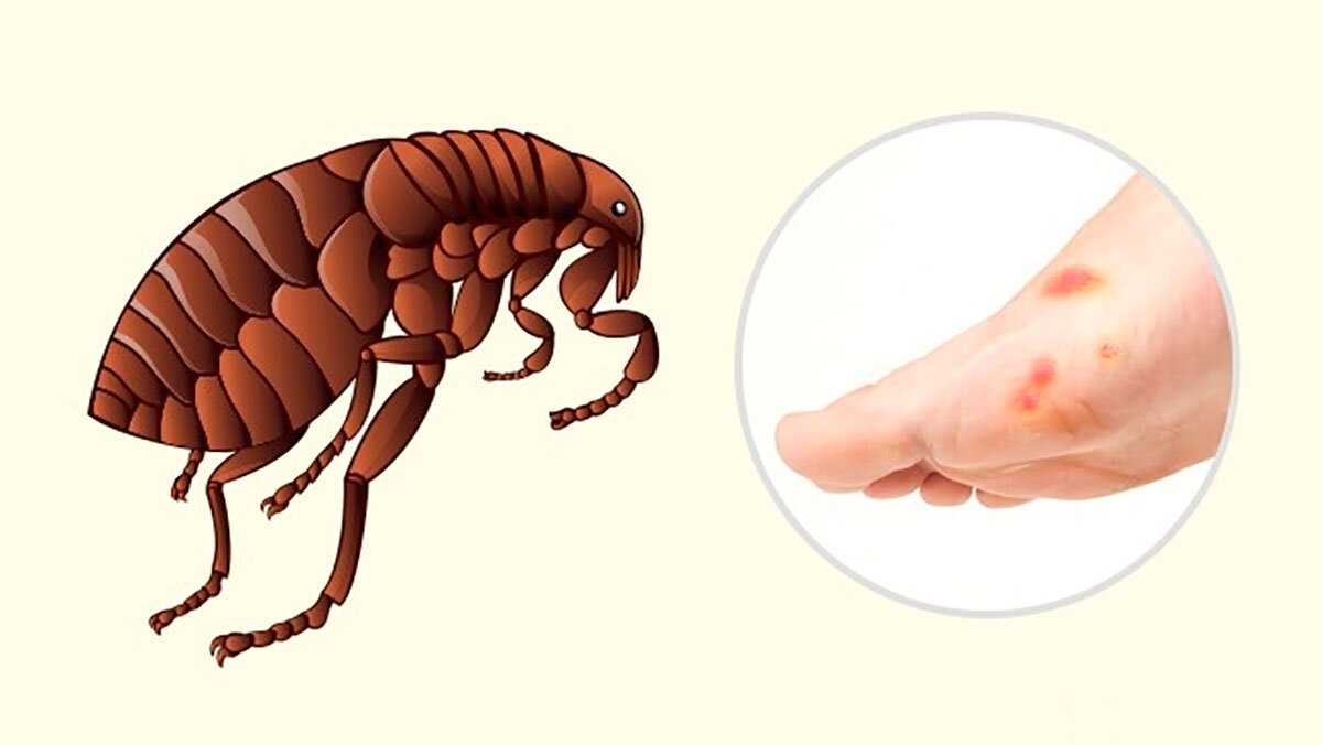 Как выглядят укусы человеческих блох