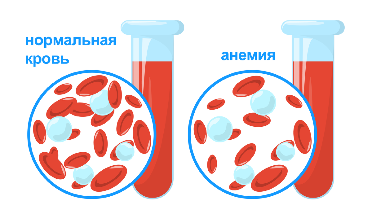 Механизм влияния содержания железа в крови на слух точно не установлен. Предположительно истина кроется в сверхвысокой чувствительности волосковых клеток к кислородному голоданию. 
