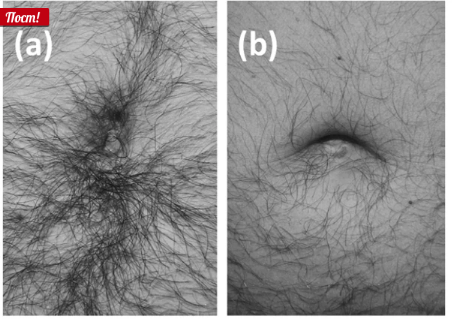 Чем больше волос вокруг пупка, тем интенсивнее в пупке образуются катышки. Источник изображения: sciencedirect.com