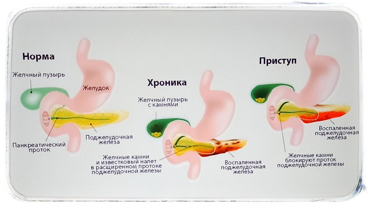 Причина поджелудочная железа