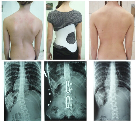 Корсет Шено - спасение от сколиоза