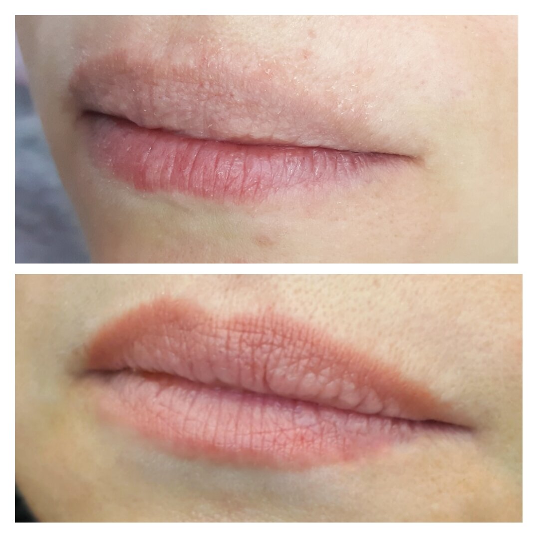 Верхнее фото до. Снизу - зажившие  губы через 4 месяца после процедуры.  Без коррекции.