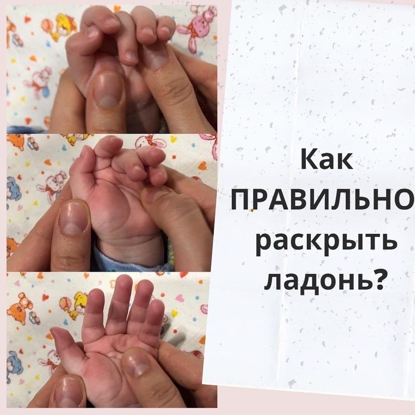 Почему ребёнок держит ручки в кулачках? ✊🏼 ⠀
Давайте разберёмся!
⠀
📍К концу беременности малыш подрастает так, что ему становится тесно в животике у мамы. Именно это и вынуждает его принимать позу эмбриона.
⠀
Такое положение приводит к усилению тонуса мышц-сгибателей и кулочки сжимаются. Так же это механизм защиты от повреждений при появлении на свет💡
⠀
📌Со временем этот механизм должен исчезнуть (к 2-3 месяцам ладонь постепенно открывается).
Но иногда мы можем наблюдать спастичность мышц и нераскрытие кулочка к положенному сроку, что замедлит развитие малыша.
⠀
📚 Малыш должен получать как можно больше информации из окружающего мира, и самый лучший способ - через контакт руками, через открытую ладонь.
⠀
❓Как помочь
Я рекомендую родителям - мягкое раскрытие кисти с отведением большого пальца!
⠀
❗❗❗
Мои рекомендации правильного раскрытия кисти:
⠀
✅Будьте осторожны!
Эта процедура для ребенка не должна быть болезненной. Все действия плавные и нежные.
⠀
✅Начинайте раскрытие с середины ладони, постепенно раскрывая всю кисть.
⠀
✅ Проработка пальцев кисти начинается с 5 пальца (мизинец) и заканчивается 1 пальцем (большой).
Медленными круговыми движениями своим большим пальцем разминаем каждый пальчик от основания до кончика, как бы по мелкой спирали.
⠀
✅ После того, как ладонь расслабится и пальцы раскроются, большой палец отводим в сторону, чтобы он был противопоставлен остальным.
⠀
✅После начала выкладывания на живот – тоже раскрываем ладошки.
Малыш в положении лёжа на животе, выводим руки вперёд, раскрываем ладони (пальцы смотрят вперёд, ладони полностью раскрыты и лежат на поверхности) и задерживаемся на 15-20 секунд, потом отпускаем.
⠀
❗Если раскрытие правильное, вы увидите, как ладонная поверхность побелела из-за растяжения ладонной фасции.
⠀
❗Не начинайте раскрытие с большого пальца. Такое раскрытие приведёт ладонь в НЕФИЗИОЛОГИЧНОЕ положение и не растянет ладонную фасцию.
⠀
Если есть вопросы – пишите в комментариях, малышам не забудьте ❤