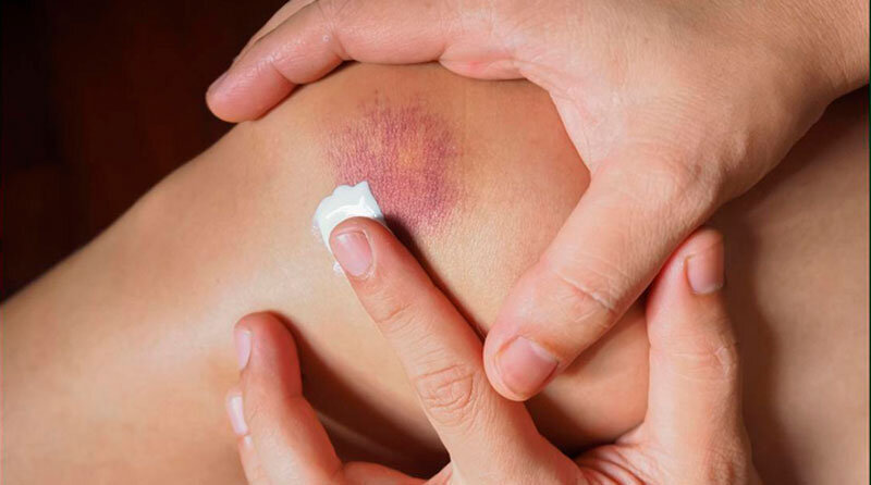 средство от синяков