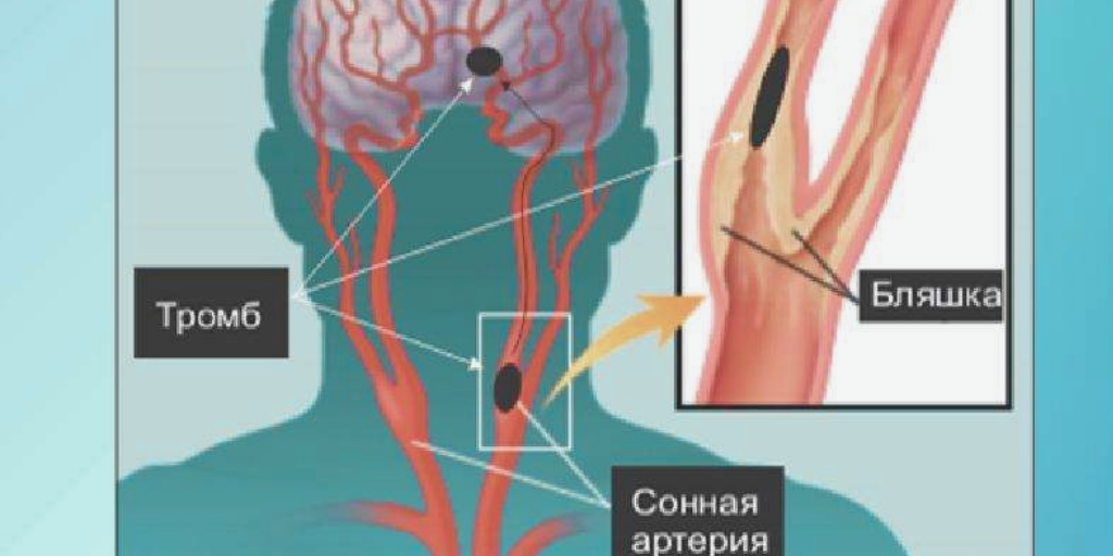 Тромб может с током крови попасть в любой отдел мозга.
