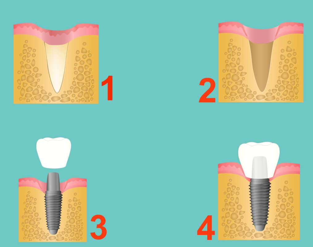 Пошагово как ставить импланты. Двухэтапная методика имплантации зубов. Этапы имплантации зубов абатмент. Поэтапная имплантация зубов.