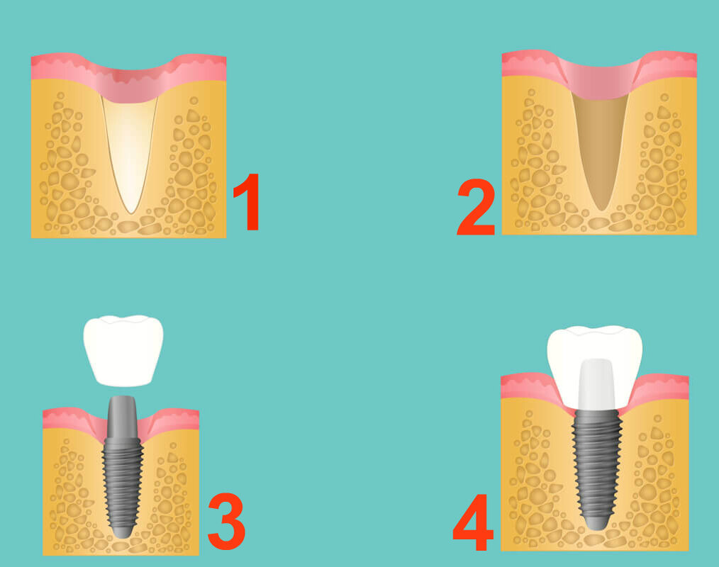 Как устанавливаются импланты зубов пошагово с фото