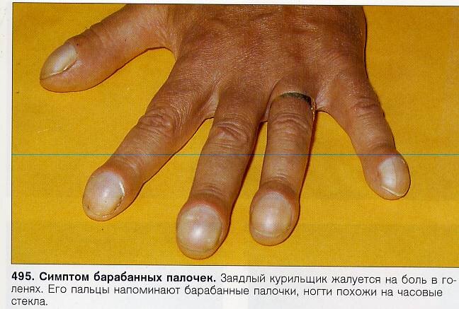 Пальцы Гиппократа – опасный симптом серьезных заболеваний