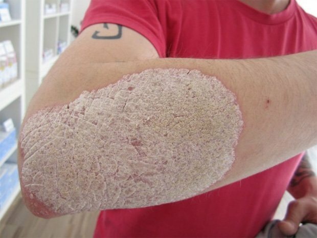 Псориаз – одна из тех болезней, что служат объектом черного юмора: хорошо, дескать, тем врачам, у которых пациенты и не умирают, и не выздоравливают.