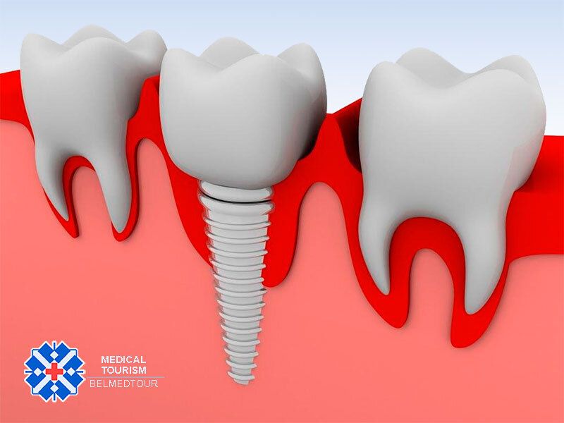 Имплант в разрезе