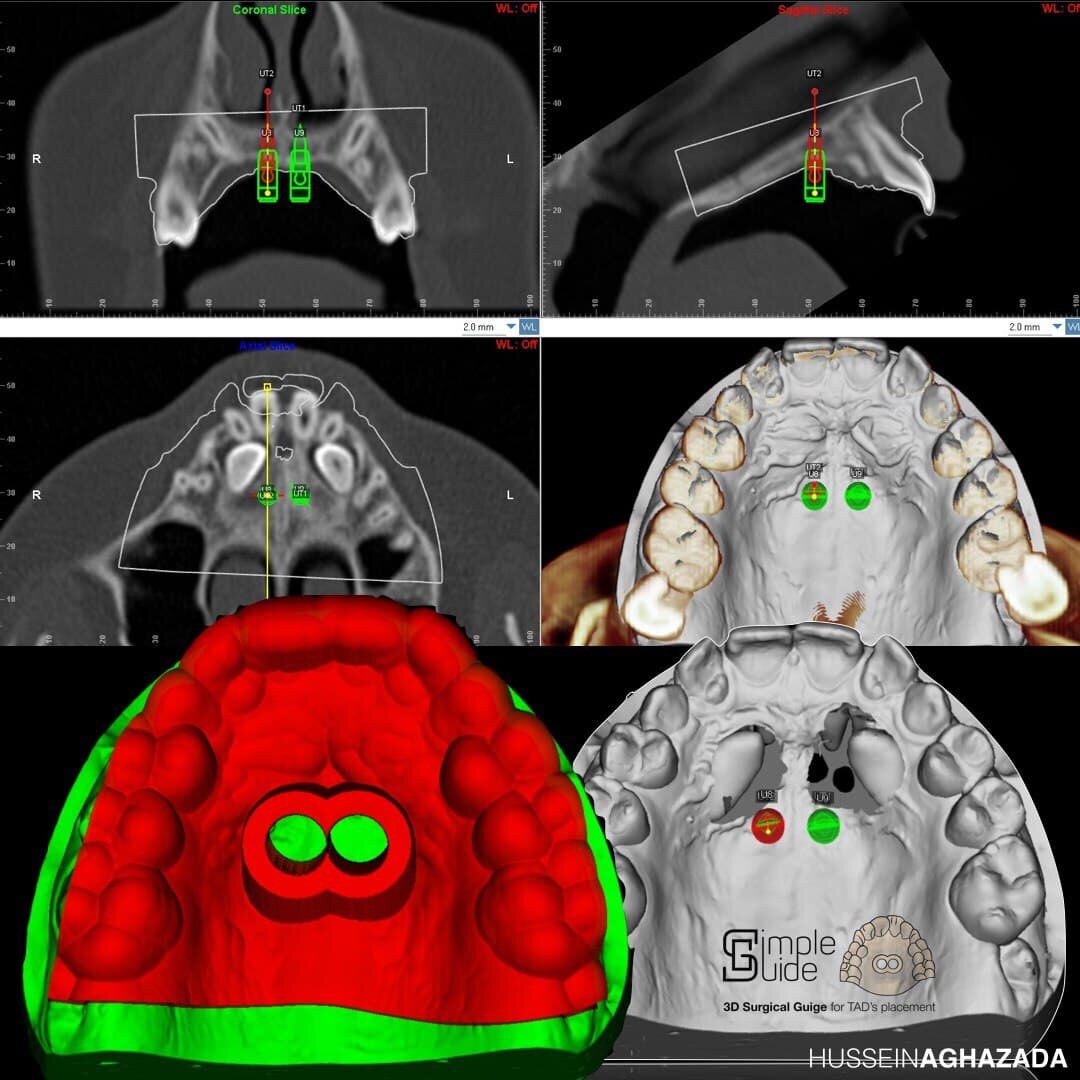 Это минивинты, которые будут использоваться как опора для аппарата расширения