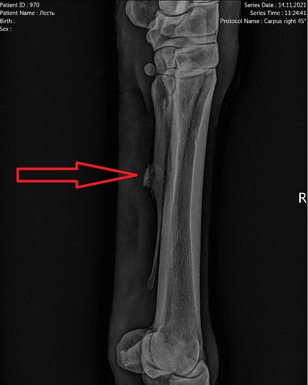 Рентген. Накостник слева на снимке по стрелке.