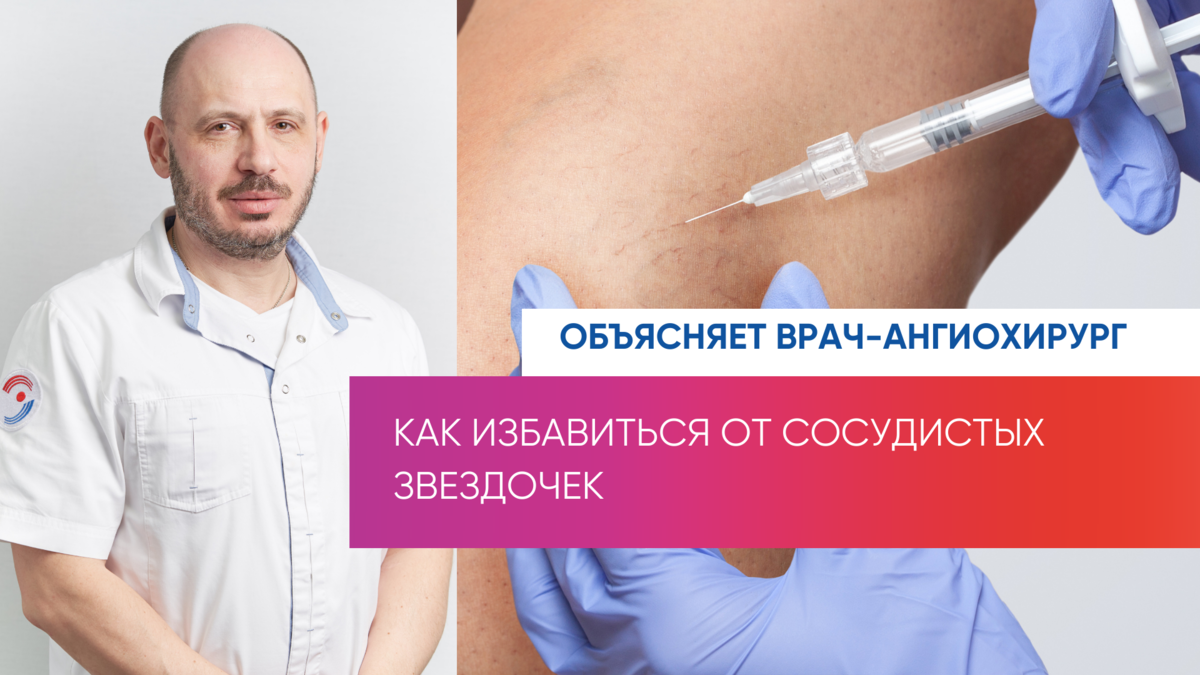 2 способа избавиться от сосудистых звездочек и сеток на ногах | Клиника  Эксперт Воронеж | Дзен