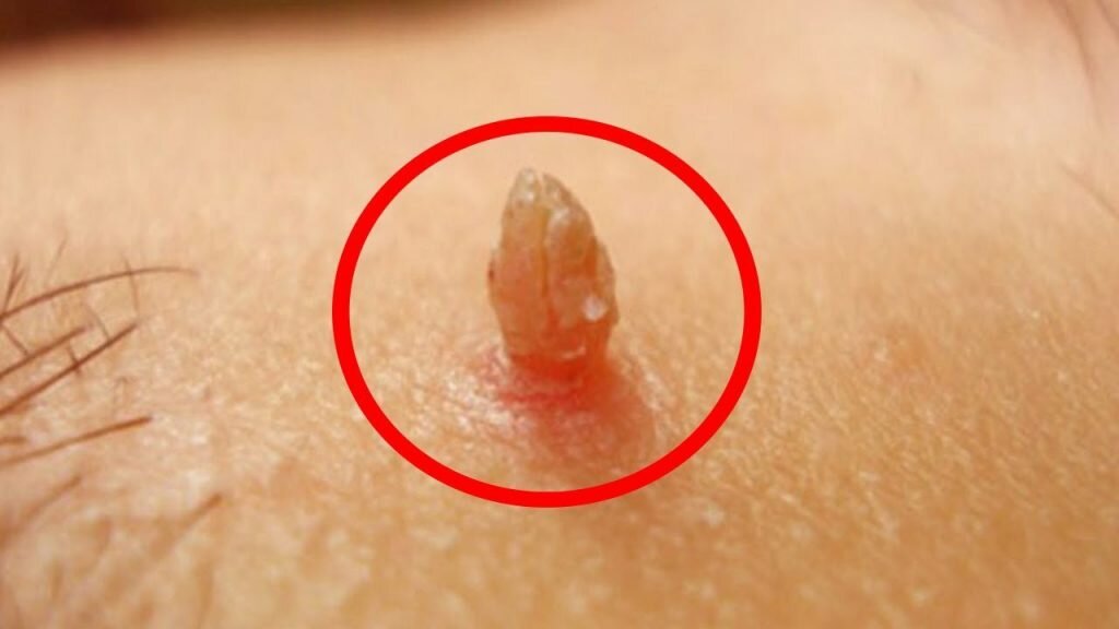 Остроконечная кондилома