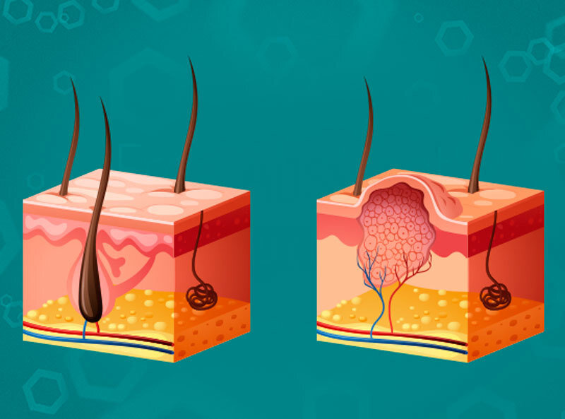 Почему у людей появляются бородавки? | Почему? | Дзен