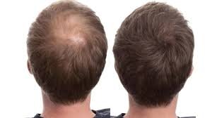 Гормоны и наследственность - главные причины облысения