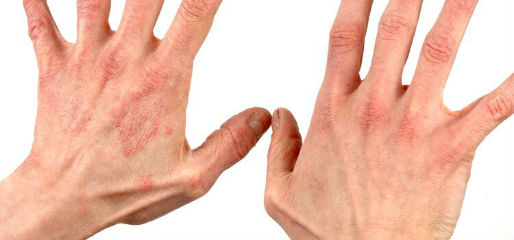 Почему трескается кожа на руках
