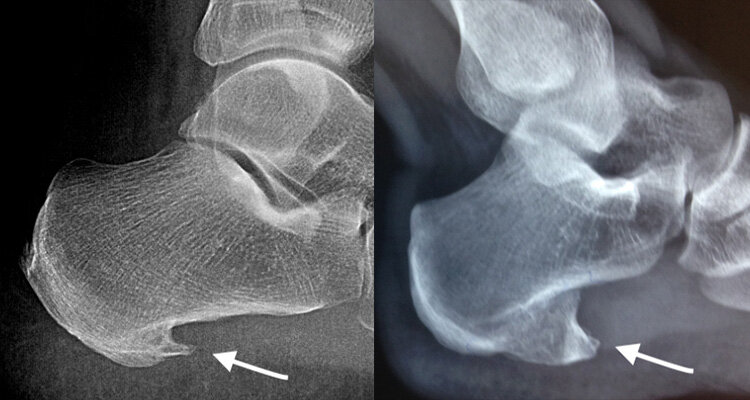 Фото пяточной шпоры на пяточной кости рентген
