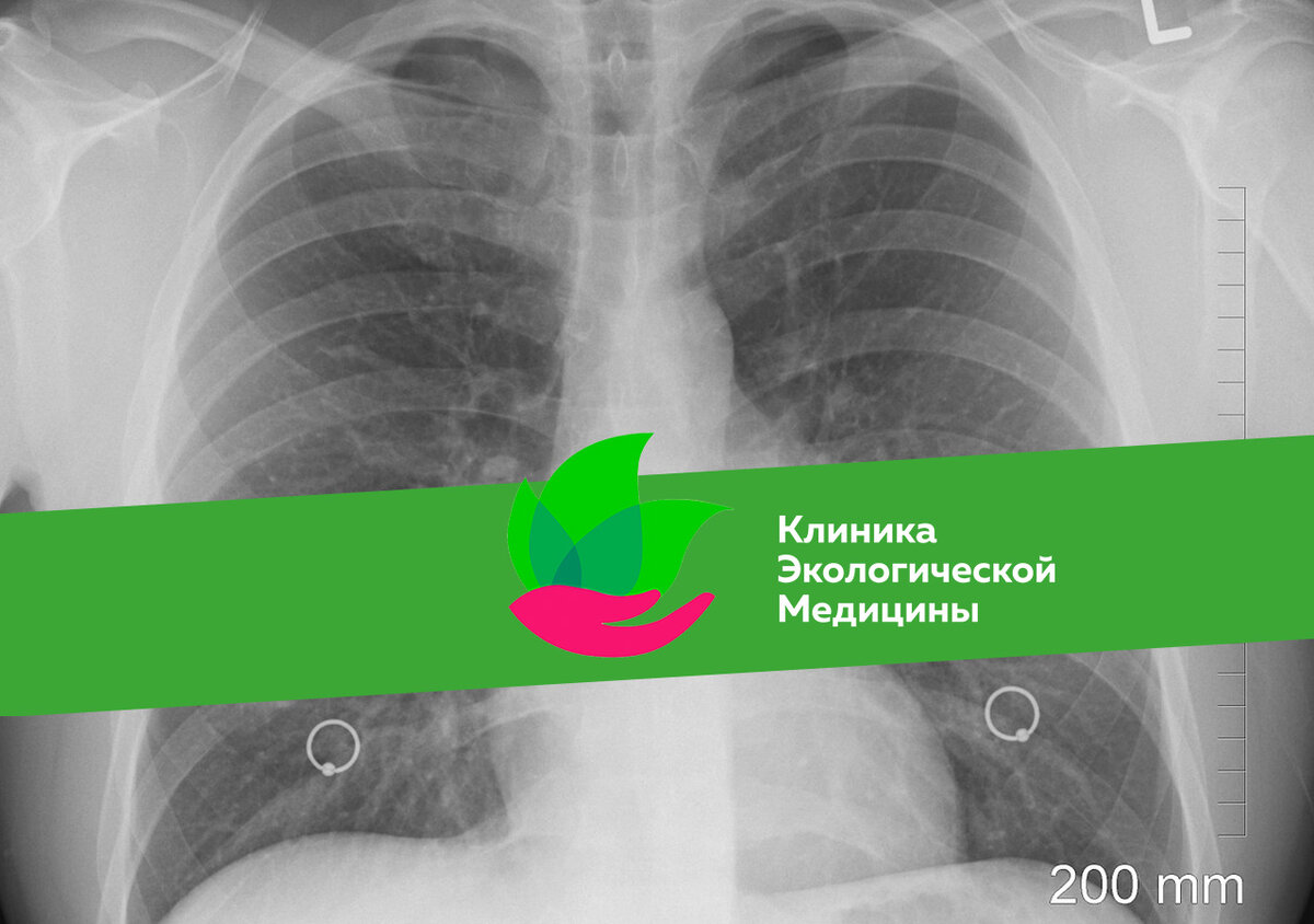 Заболевание провоцируется нарушением работы печени и поджелудочной железы, что приводит к повышению давления в желудке 