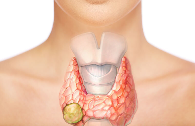 Зоб в горле. Аутоиммунный тиреоидит зоб. АИТ зоб щитовидной железы. Щитовидная железа зоб узлы. Лимфоматозный тиреоидит.