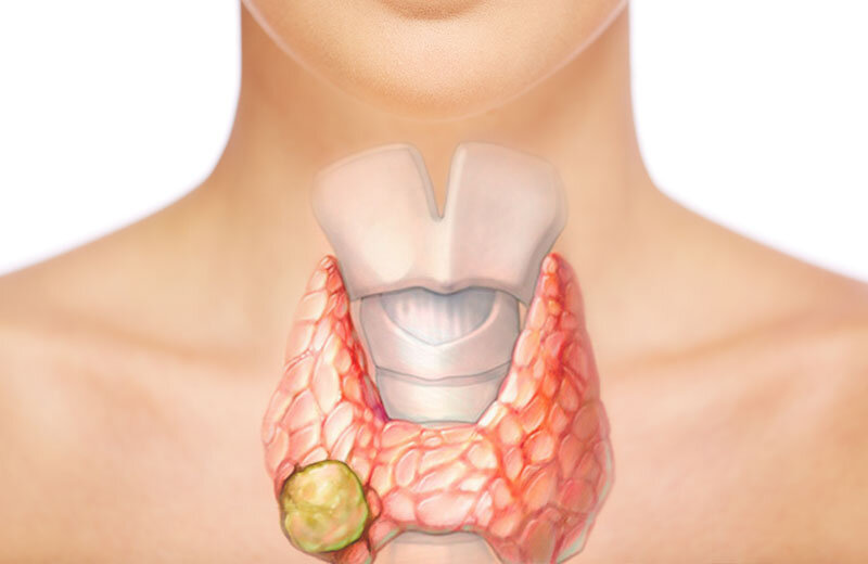 Узлы в щитовидной железе. Тироид для щитовидной железы. Щитовидка железа щитовидная. Щитовидная железа зоб узлы.